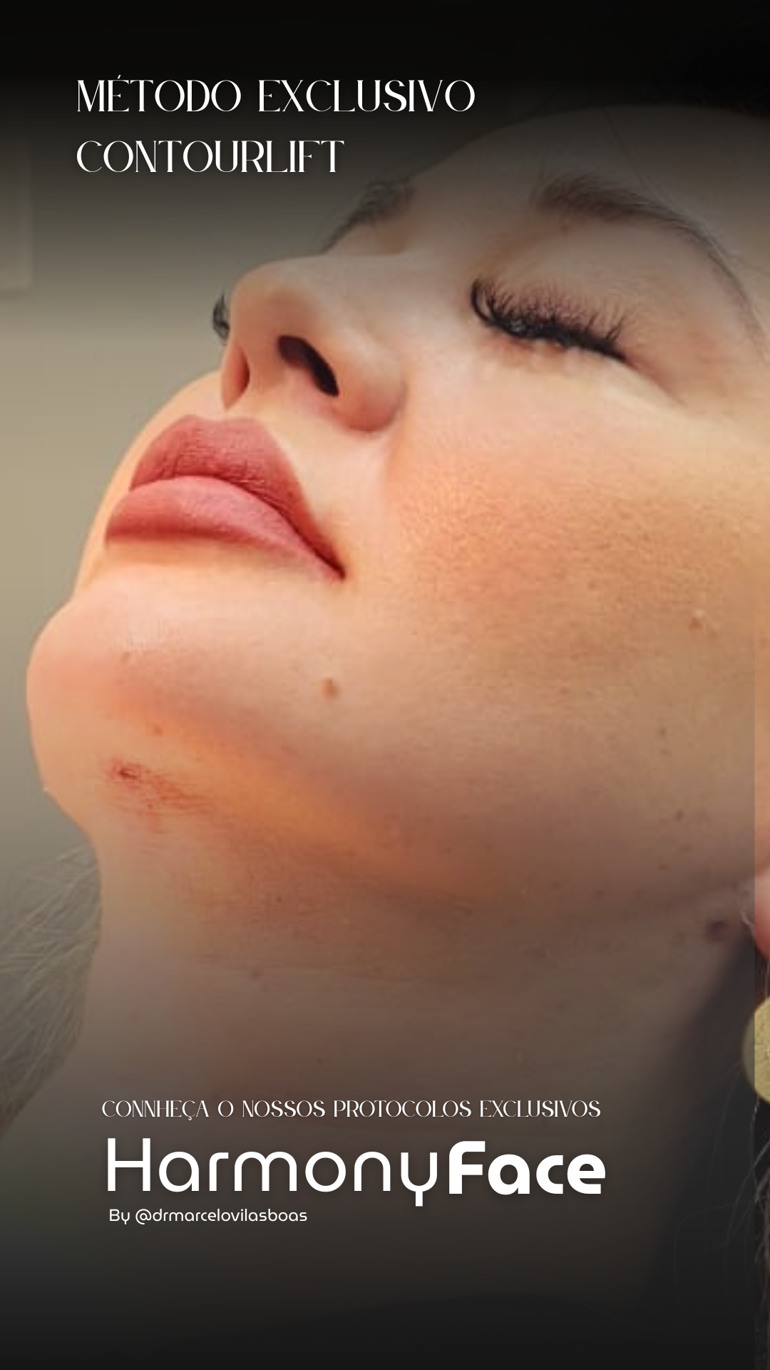 ContourLift® - Resultado Natural